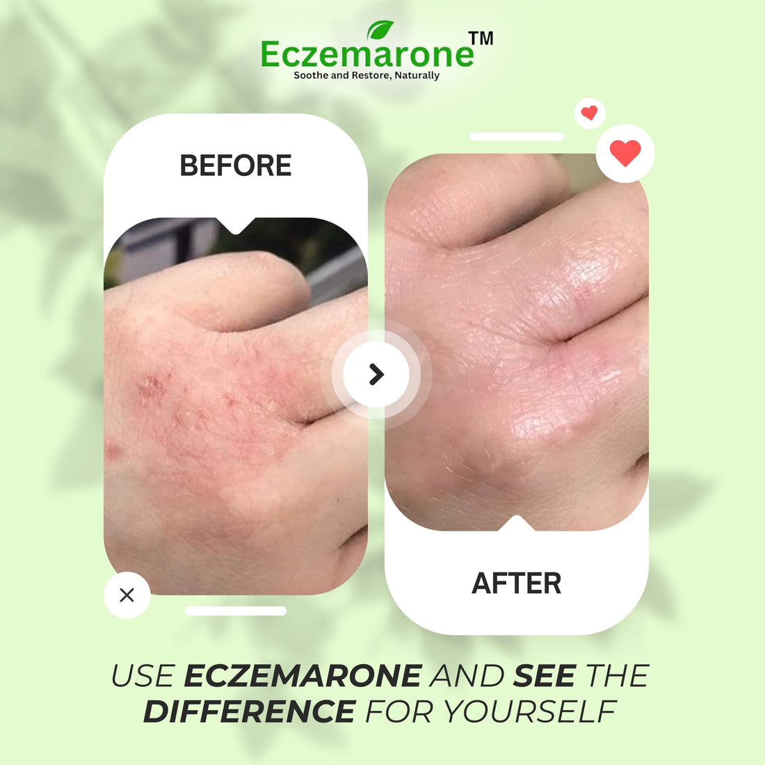 Eczema is on the Rise – Protect Your Skin Now! 🌿🔥